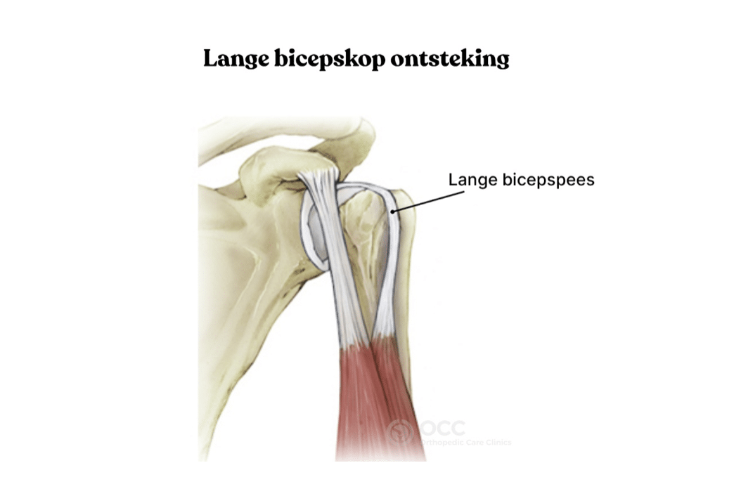 Anatomische weergave van het schoudergewricht met de lange bicepspees en ontsteking.
