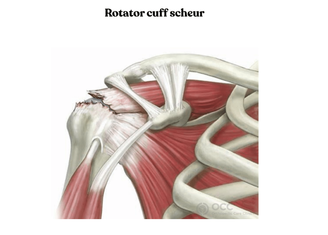 Anatomische tekening van de schouder met rotator cuff ruptuur.