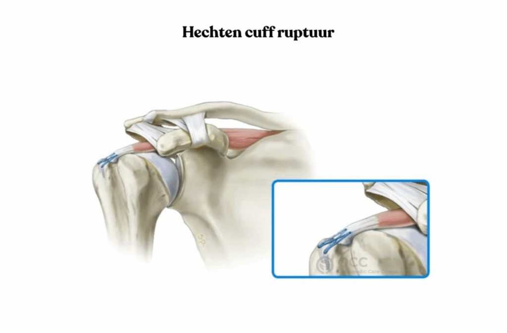 Anatomische tekening van de schouder met hechten van een rotator cuff ruptuur.