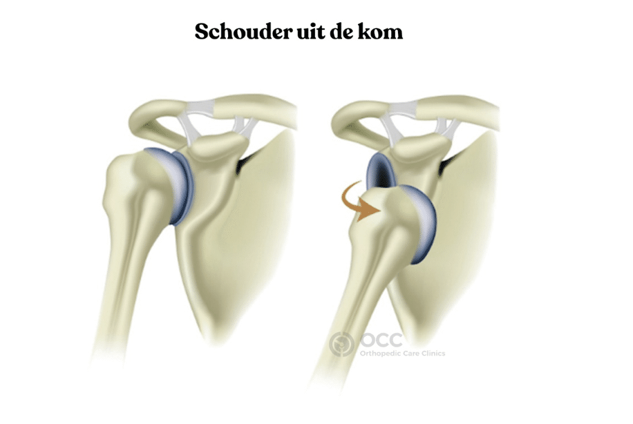 Schematische weergave van een schouder die uit de kom is (schouderluxatie).
