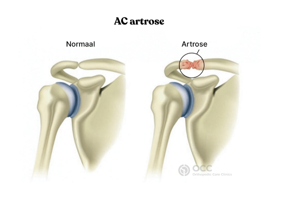 Anatomische vergelijking van een normaal AC-gewricht en AC artrose in de schouder.