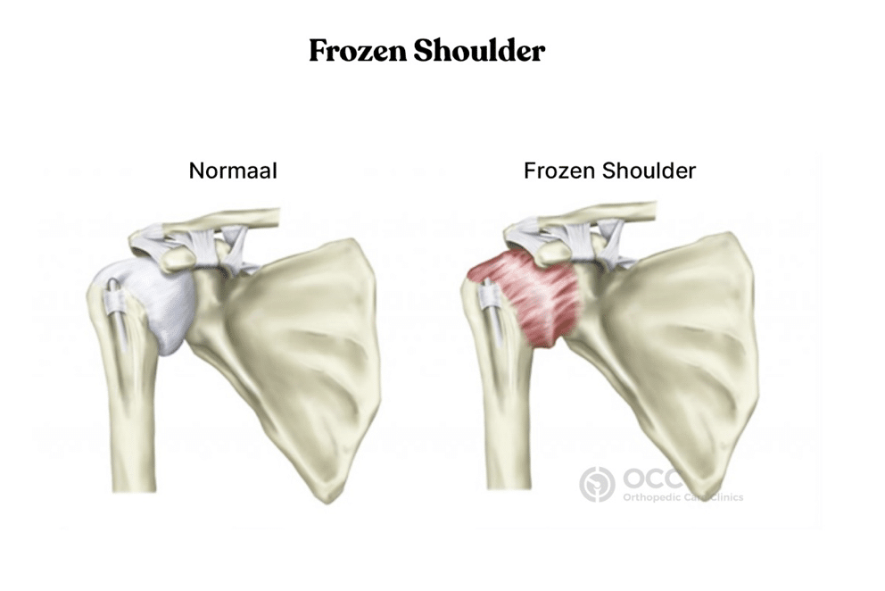 Anatomische tekening van een frozen shoulder met kapselverdikking.