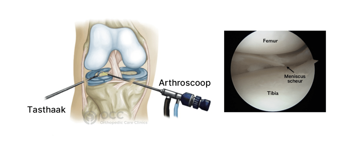 Anatomische illusatrie voorzijde meniscusscheur behandeling met arthroscoop en testhaak, naast de illustratie is een echte foto van binnenkant knie en de meniscusscheur.