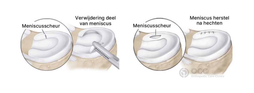 Anatomische illustratie met weergave verwijdering deel van meniscus en het hechten van de scheur.